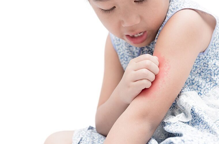 Allergy Group Hives